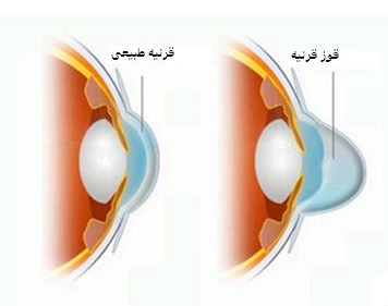 دانلود پاورپوینت بیماری قوز قرنیه یا کراتوکونوس