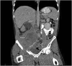 پاورپوینت ABDOMEN & PELVIS PATHO